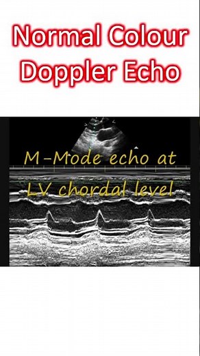 Normal Colour Doppler Echocardiogram