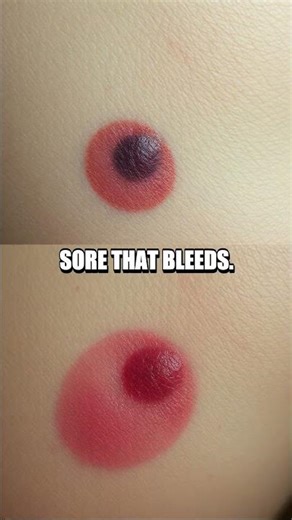 Melanoma Warning Signs You Shouldn’t Ignore