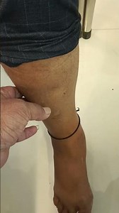 "Understanding Pitting Edema: Causes, Symptoms, and Treatment"