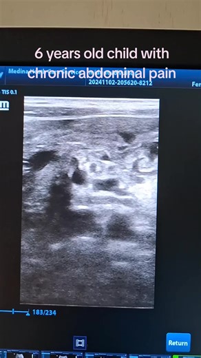 Understanding Mid Gut Volvulus Diagnosis via Ultrasound