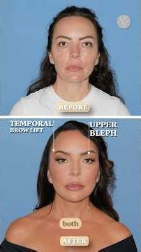 Do you need a brow lift or eyelid surgery?✨