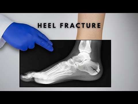 Understanding Stress Fractures of the Heel Bone: Causes, Symptoms, and Treatments