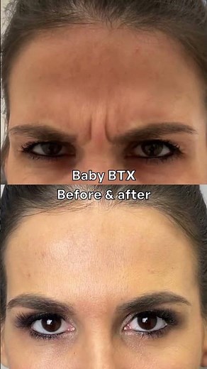Sarasin Clinic baby Botox before after