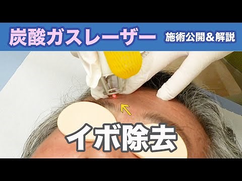 [Treatment Video] Carbon dioxide laser treatment fully revealed! Wart removal!