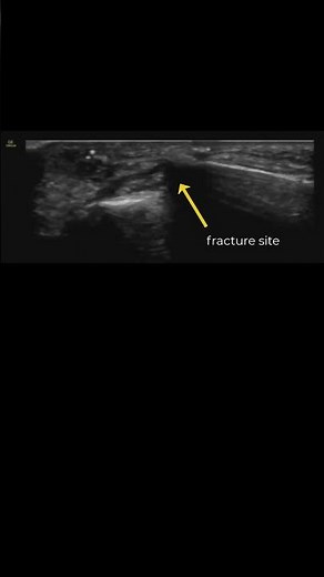 Metacarpal Fracture #POCUS Guided Ulnar Nerve Block and Reduction #pocus