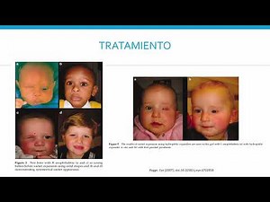 Anophthalmos, Microphthalmos, Hypotelorism Dr. Victor Manuel Villar Calvo