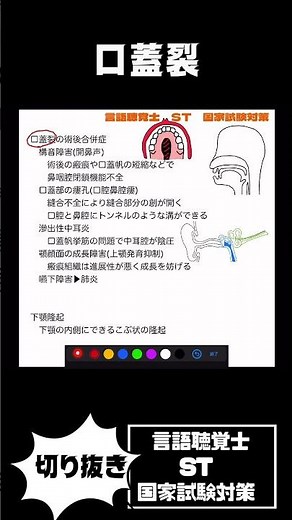 27-179 口蓋裂術後合併症 開鼻声 口腔鼻腔瘻 滲出性中耳炎 上顎発育抑制があります！