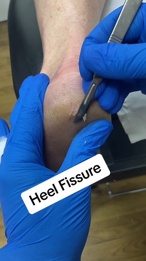 Podiatrist Demonstrates Removal of Painful Cracked Heel Fissure