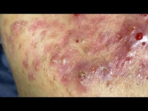 "Deep Pus Filled Pimple Burst | Huge Infected Acne Cleanup!"