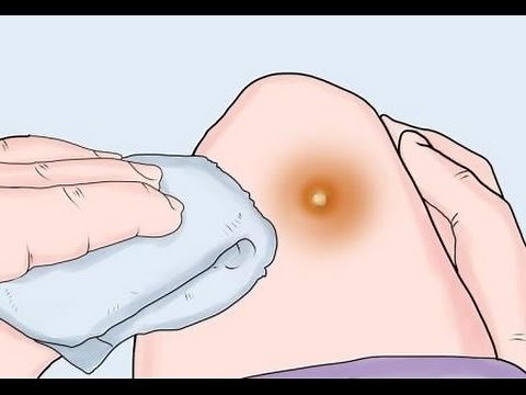 7 Remedios caseros para tratar forúnculos