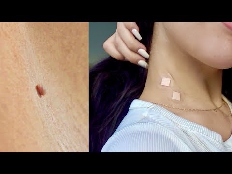 HOW TO REMOVE SKIN TAGS OVERNIGHT & NATURALLY | DIY (Easy At Home Mole Removal) 100% Works!