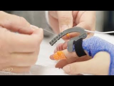Isoforce Outrigger Dynamic Orthosis Fabrication with Orficast More