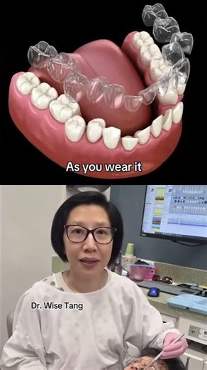 How Invisalign works?