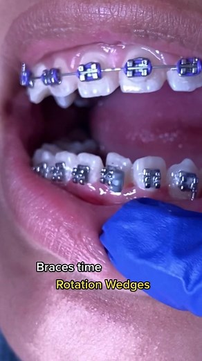 Braces time! #braces #brackets #ortodoncia #orthodontics #smile #texas #mexico