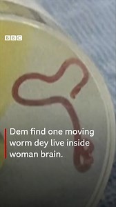 2.4K views · 52 reactions | For di first time for world, scientist say dem find 8cm worm alive dey chill inside di brain of one Australian woman. Dem comot di "string like structure" from di woman frontal lobe wey bin don spoil for surgery last year. Di woman bin get symptoms wey doctors call unusual - from stomach pain, cough and night sweats wey come grow to increasing forgetfulness and depression. Di red parasite fit don dey inside dia for up to two months. | BBC News Pidgin | Facebook