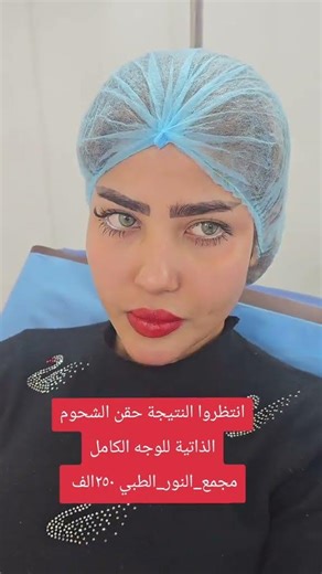 انتظروا نتيجة حقن الشحوم الذاتية للوجه بــ250 الف مجمع النور الطبي