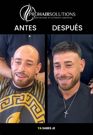 Prótesis capilar en Lorca: impresionante cambio de look