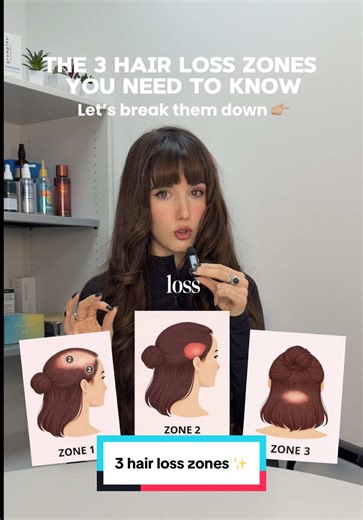 Understanding the 3 Key Hair Loss Zones