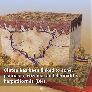 8 Signs You Have A Gluten Intolerance, according to Science... | Power of Positivity