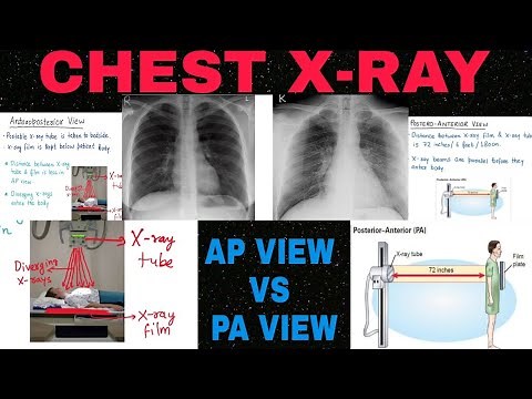 Chest Xray : PA vs AP view