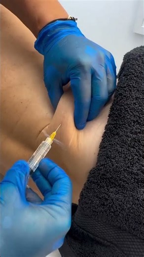 Non-Surgical Liposuction 👀🔥 How Fat-Dissolving Injections Work?