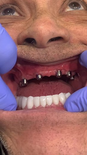 Not all dental implant centers are the same. Learn about the Bionic Smile experience.