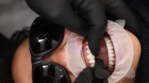 A tiny moment. A big impact. This is Dr. Keller placing a CeraRoot ceramic implant: a non-metal, biocompatible option we often recommend for front teeth or patients looking for a more natural approach to dental care. At Smiles By Design, Rejuvenating Dentistry, we believe your health and your smile deserve more than one-size-fits-all solutions. -No metal in the body -Gentle on gum tissue and bone -No gray shadow near the gumline -Made to blend beautifully with your natural teeth This is a great 