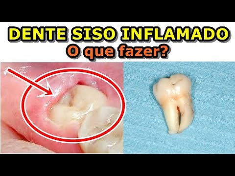 Inflamed wisdom tooth, what to do?