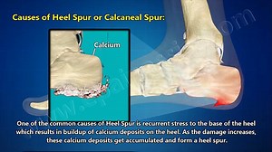 Heel Spur or Calcaneal Spur: Treatment, Causes, Symptoms, Prevention