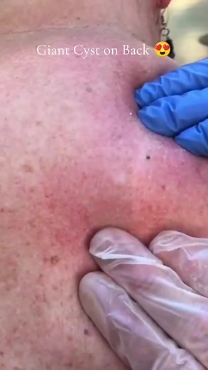 Giant Cyst on Back | Satisfying Pimple Popping Video