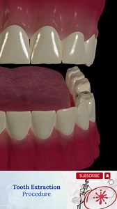 51K views · 682 reactions | Tooth extraction is a procedure in which...