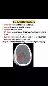 77K views · 579 reactions | #hamorrage #hematoma #anatomy #ctscan | CT Scan and MRI study | Facebook