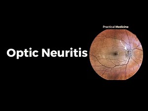 Optic Neuritis: A Quick Overview