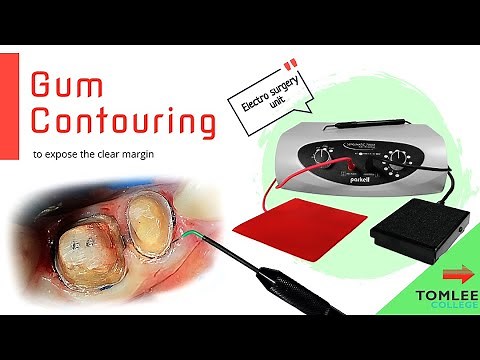 Gum Contouring (Gingival Contouring) with Electro Surgery / Crown Preparation / Crown Lengthening