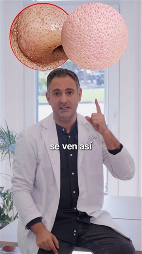 Dr. Carlos Morales Raya Dermatólogo on Instagram: "Si tu nariz y tus poros se ven así, podemos pasar de esto 👉 a esto 👉 sin herramientas agresivas. Esta es una rutina exprés de limpieza que realmente funciona. 1️⃣ Doble limpieza nocturna Empieza con un limpiador en aceite o micelar y continúa con un limpiador con ácido salicílico. Limpian el poro en profundidad sin irritar la piel. 2️⃣ Niacinamida mañana y noche Ayuda a regular la producción de sebo, mejora la textura y mantiene el poro más li