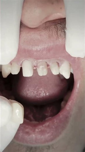 Solving malocclusion of anterior root canal treated teeth with zirconia crowns #dentalclinic
