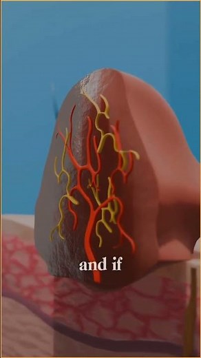 🚫 STOP! Don’t pluck skin tags! ❄️ Try freezing them with nitrogen for a safe and effective removal!