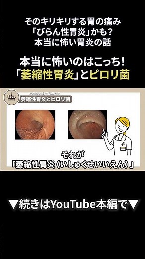 46 そのキリキリする胃の痛み、「びらん性胃炎」かも？本当に怖い胃炎の話②｜【胃腸と内視鏡の専門チャンネル】たなか内科クリニック #shorts