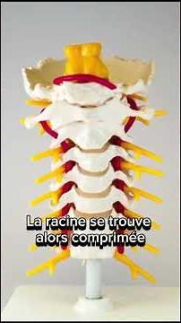 Qu'est ce qu'une névralgie cervico-brachiale ?