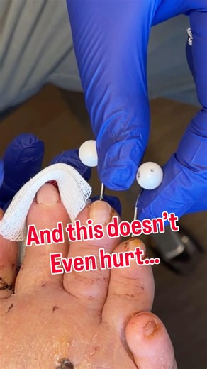 Minimally Invasive Hammer Toe Surgery