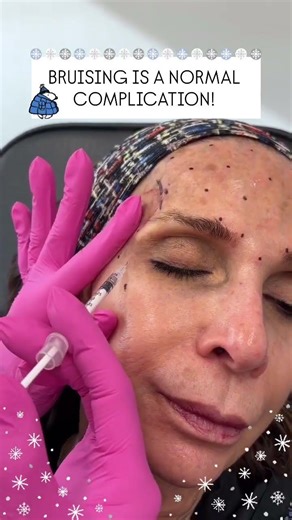 Bruising is a Normal Complication