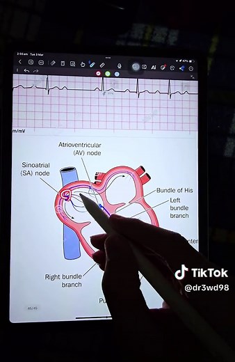 Understanding Second Degree Heart Block