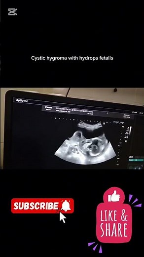 Cystic hygroma with hydrops fetalis