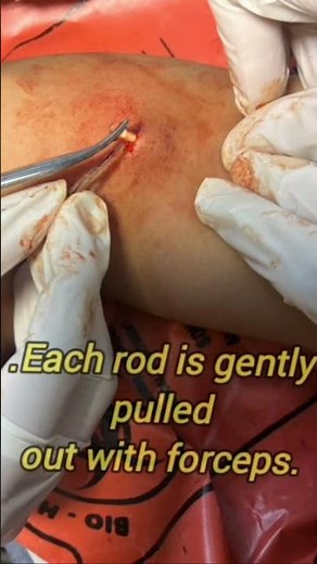 Jadelle Implant Removal : what to expect #JadelleRemoval #ImplantRemoval #ContraceptiveImplant