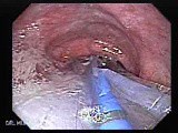 Esophagus - Pneumatic Dilation for Achalasia - Beginning of the Procedure • Video • MEDtube.net