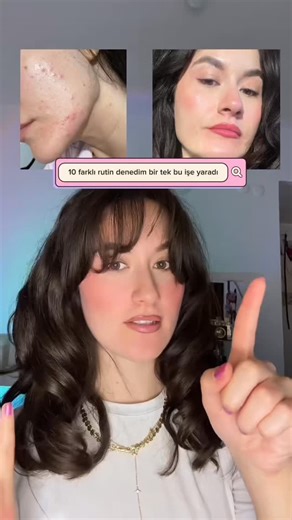 İrem on Instagram: "Kurtarıcınız olmaya geldim asklarım 🤍 biliyorum bu süreç çok zor ve herkese ilaç yazıp gönderiyorlar ama ilaçsız bir şekilde ve böyle bir rutinle benim gibi tüm sivilcelerinden kurtulabilirsin ✨ Sorularınız varsa yorumlarda yanıtlarım umarım bu video size yardımcı olmuştur 🙌🏻 #skincare #acnefreeskin #acnetreatment #skincarethatworks #skincareroutine"