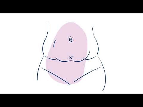 Acessa Procedure Overview Animation