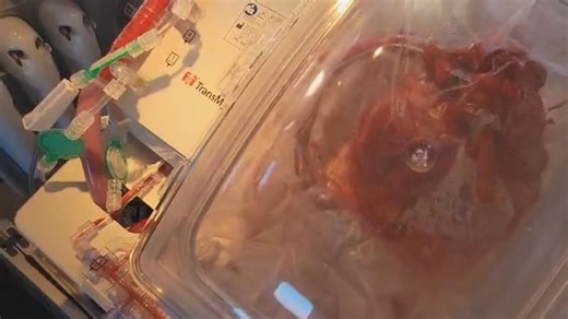 Heart transplants may soon be more accessible thanks to 'heart-in-a-box' tech