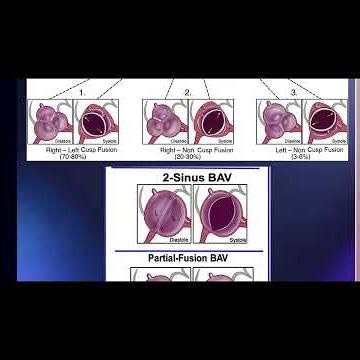 Mastering Bicuspid Aortic Valve Classification: Siever's vs International Consensus
