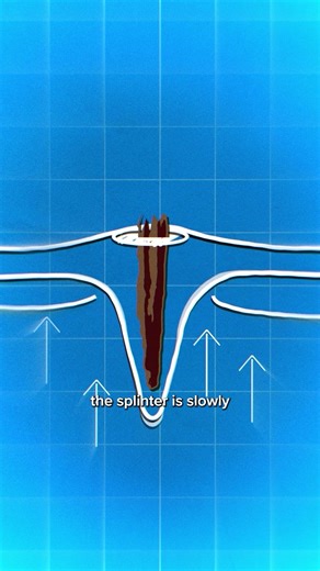 How To Remove a Splinter